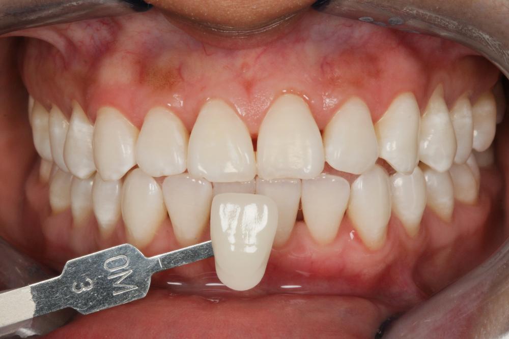 after teeth whitening
