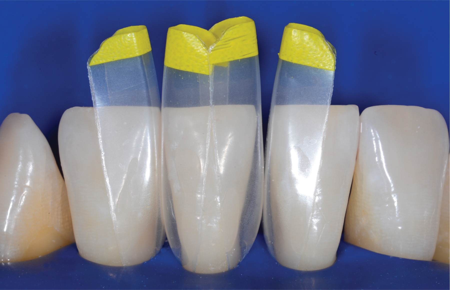 tooth model showing how bioclear works