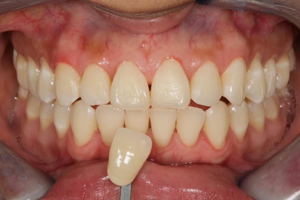 before teeth whitening
