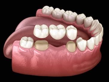 dental bridge in south charlotte
