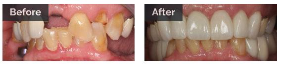 Full teeth view of before and after dental implants and crowns