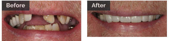 Before and after picture of a broken smile getting fixed, charlotte nc