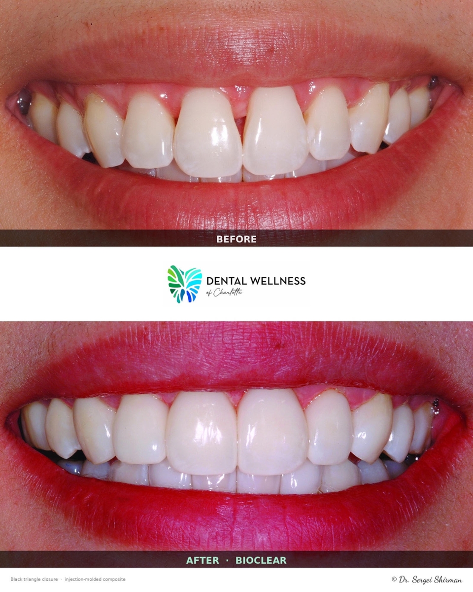 before and after image of a bioclear case