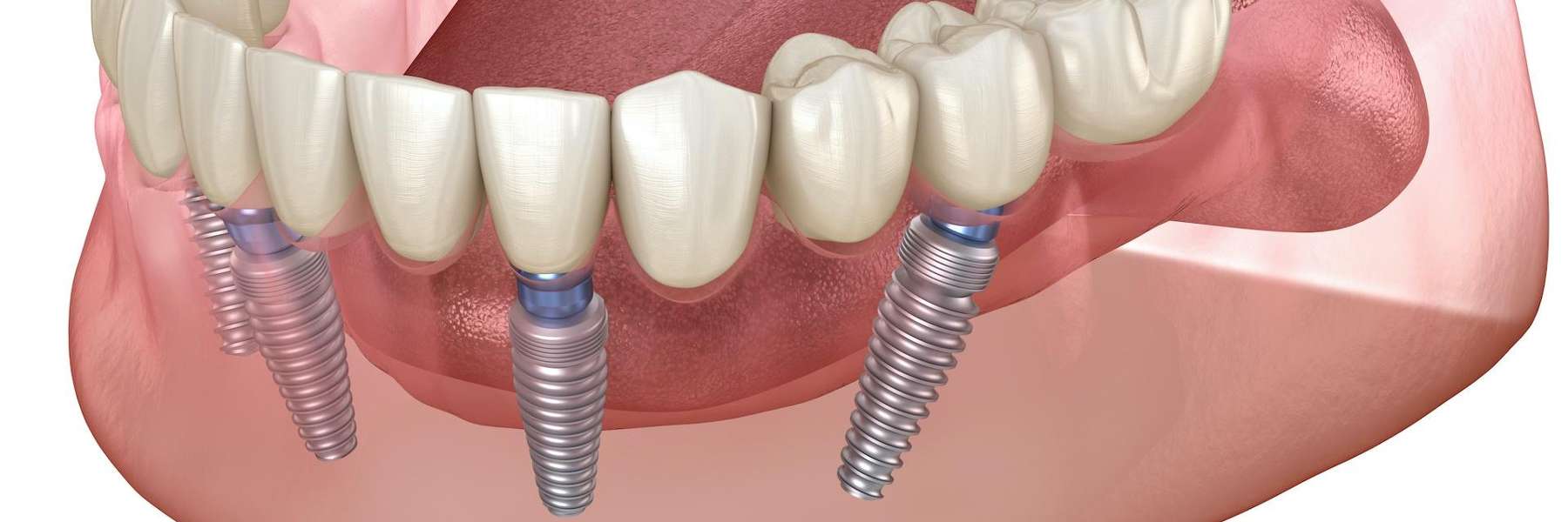 Dental Implants Illustration | South Charlotte, NC