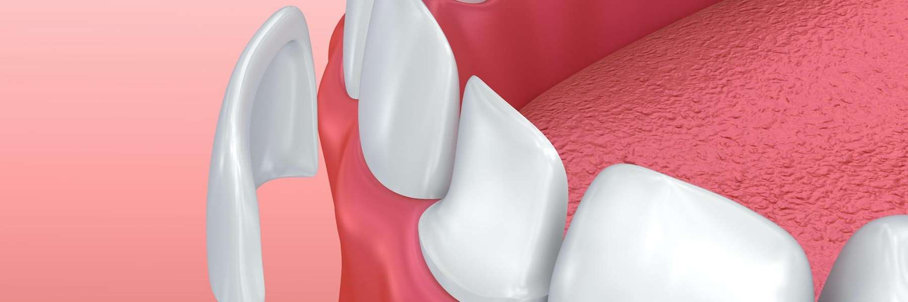 Image of veneer being placed on a tooth, charlotte nc