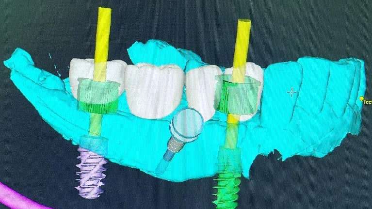dental implants South Charlotte, NC
