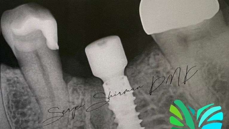 X ray of dental implant