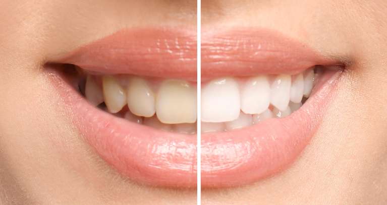 KöR whitening south charlotte, nc