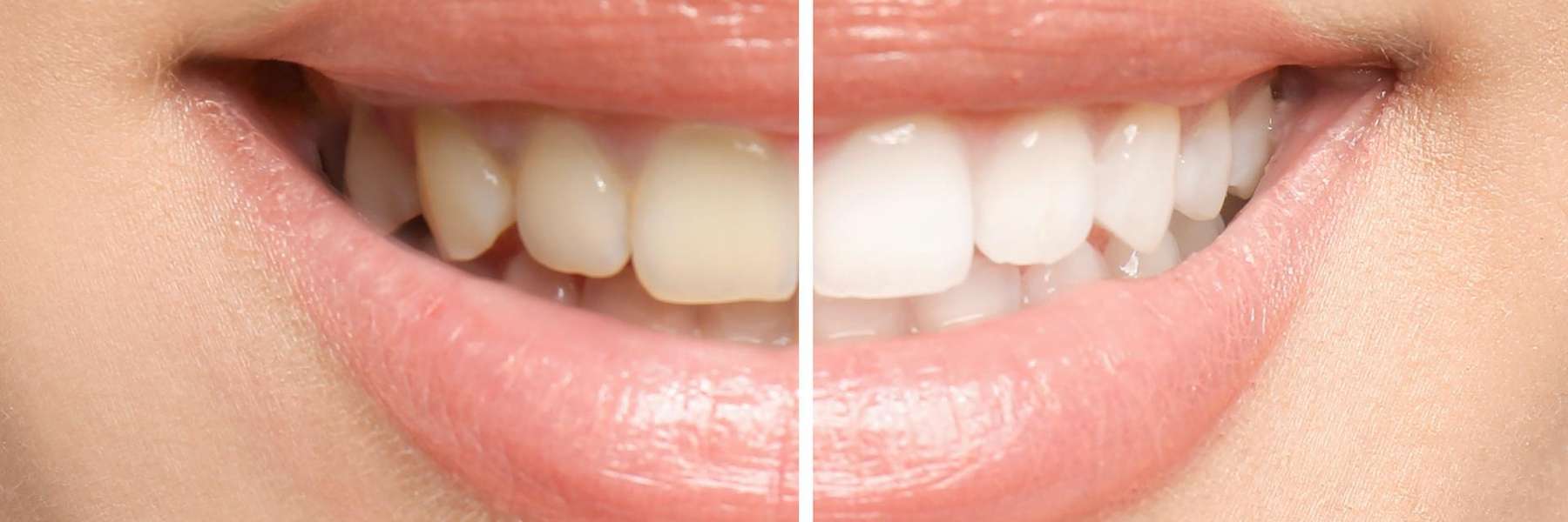 smile before and after bioblear treatment