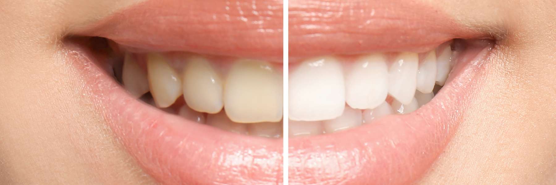 Before and after mouth with teeth whitening, south charlotte nc