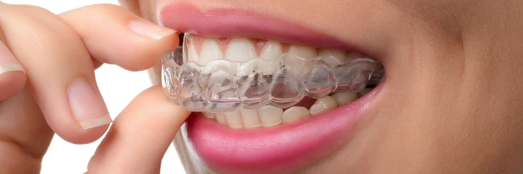 person using mouthguard for sleep apnea