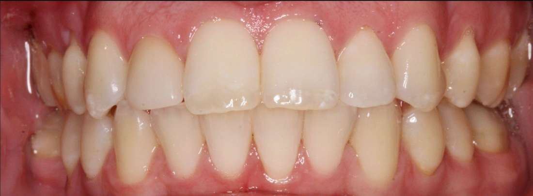 after braces, oral surgery, crowns, veneers, and whitening