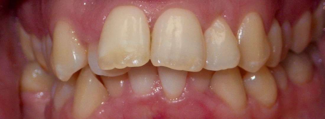 before braces, oral surgery, crowns, veneers, and whitening