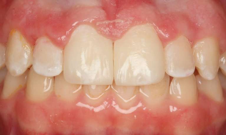 BioClear-Smile-Enhancement-After-Image