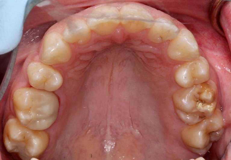 after extensive multi-disciplinary treatment plan