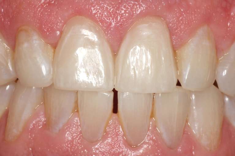 after innovative CEREC technology restoring a chipped tooth