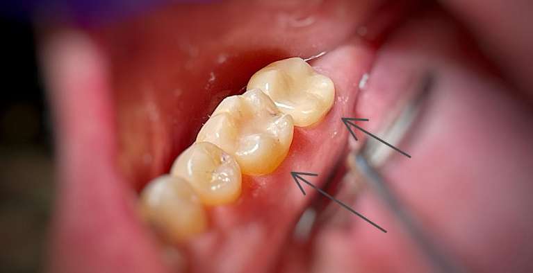 same day crowns, charlotte- after photo