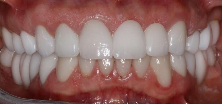After combination of jaw therapy and complete dental reconstruction, south charlotte nc