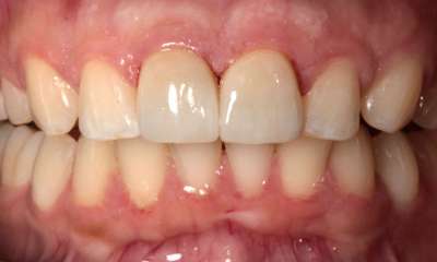 dental crowns, south charlotte- After Photo