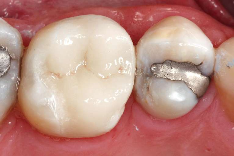 After Same-Day Porcelain Tooth Crown