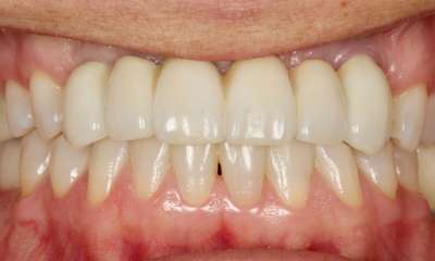 Charlotte dental implants- after photo