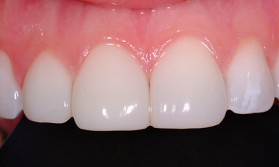 After treatment - Fixing a chipped tooth with Bioclear
