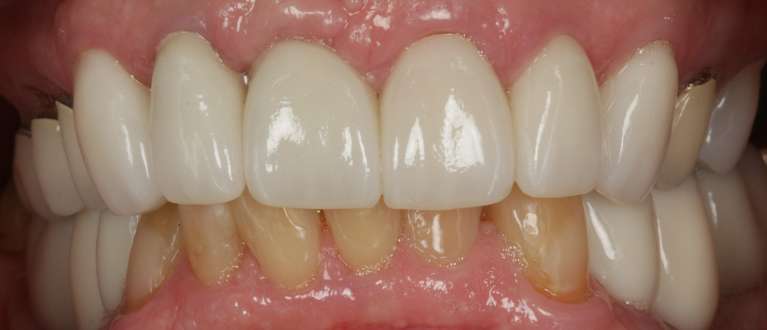 implants in charlotte- after