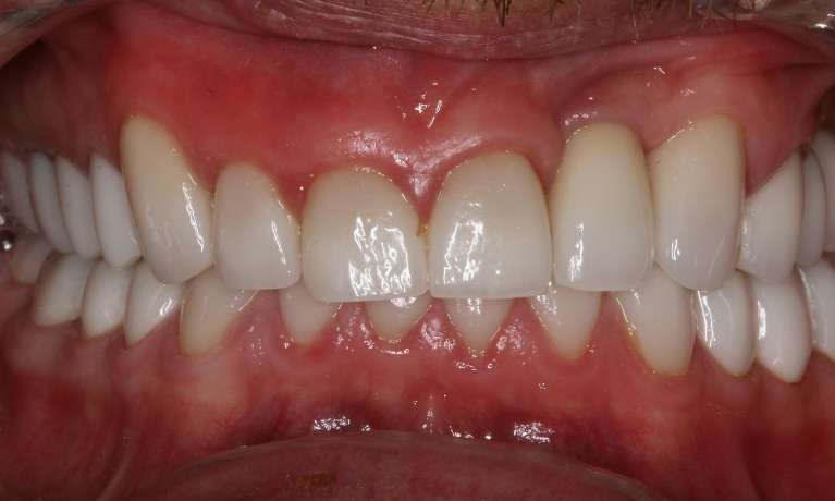Implants in Charlotte- After