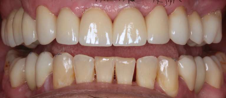 After full mouth rehabilitation, south charlotte nc