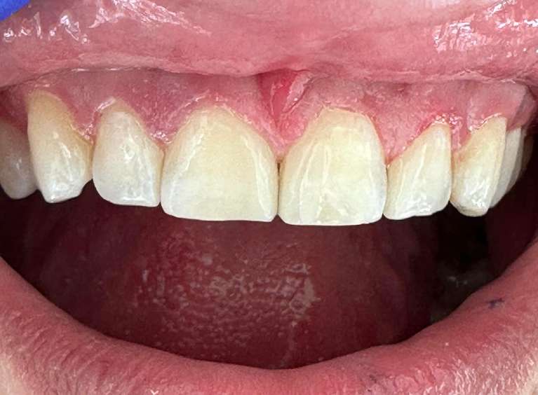 Non- Invasive Dental Treatment in Charlotte- After
