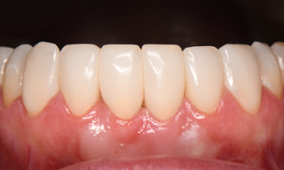 After treatment - Removing Black Triangles with Bioclear