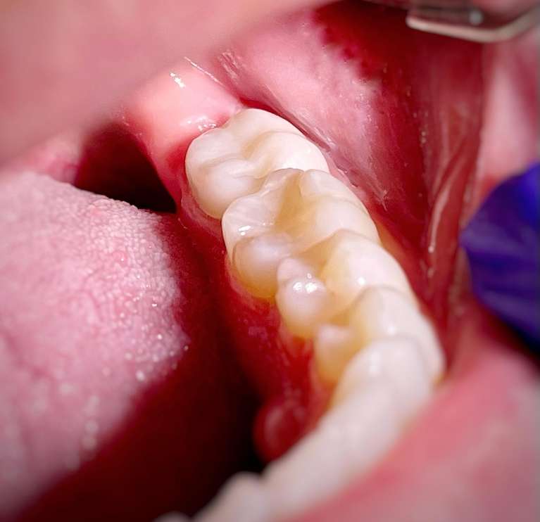 same day dental crowns in south charlotte- after photo