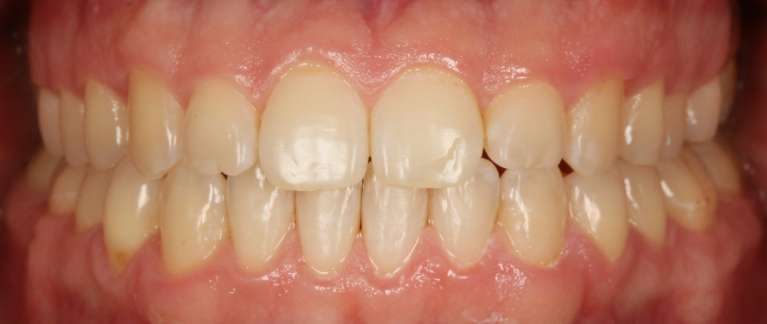 clear aligners in South Charlotte- After