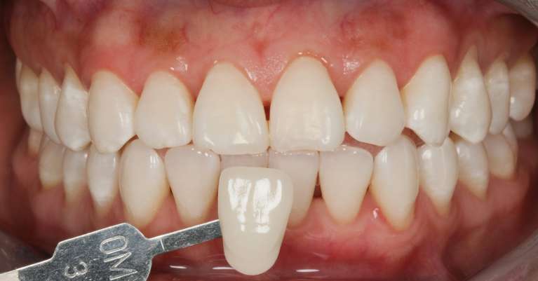 Teeth whitening in Charlotte, NC- After