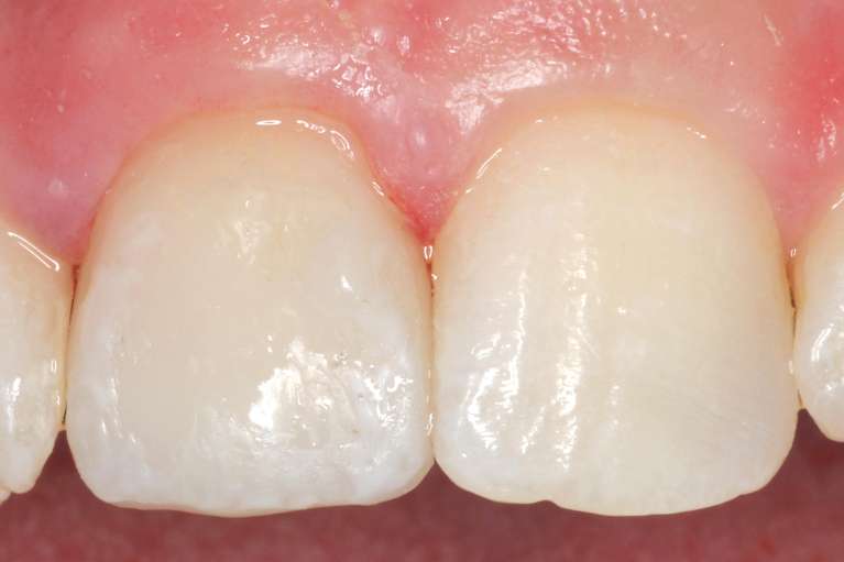 After Dental Veneers