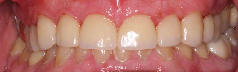 after full mouth rehabilitation, south charlotte nc