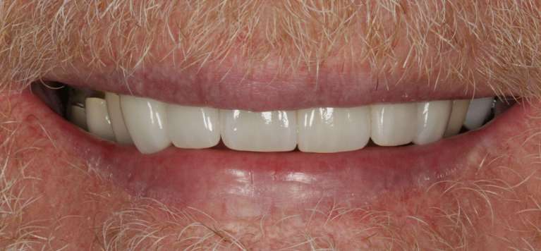 cosmetic dentistry case in charlotte- after