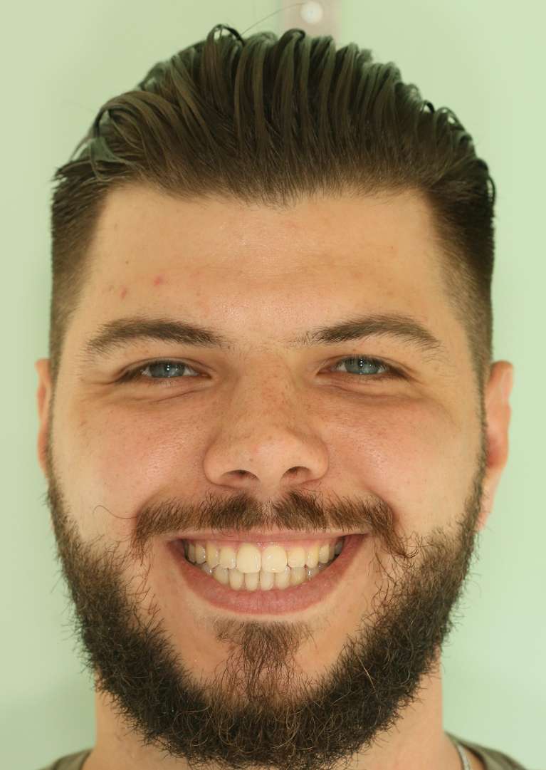 clear aligners in Charlotte- After