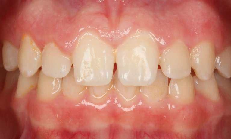 BioClear-Smile-Enhancement-Before-Image
