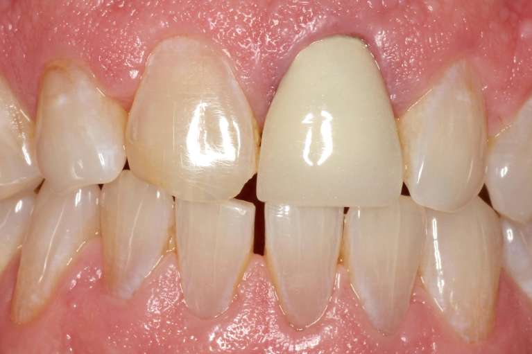 before innovative CEREC technology restoring a chipped tooth