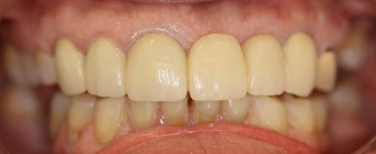 Before combination of jaw therapy and complete dental reconstruction, south charlotte nc