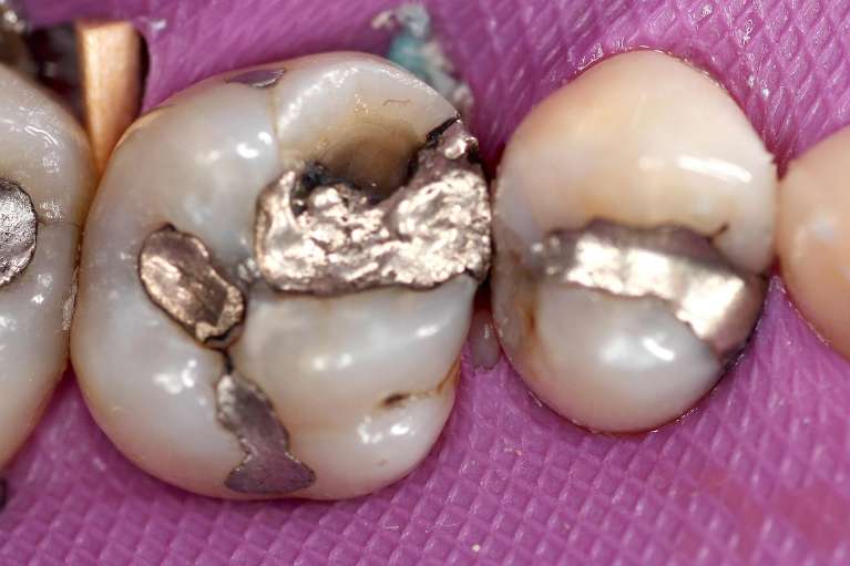 Before Same-Day Porcelain Tooth Crown