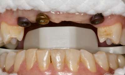 Charlotte dental implants- before photo
