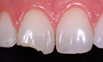Before treatment - Fixing a chipped tooth with Bioclear