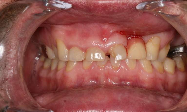 Implants in Charlotte- Before