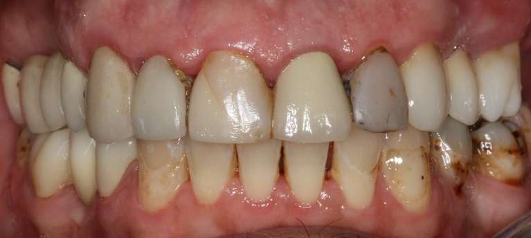 Before full mouth rehabilitation, south charlotte nc