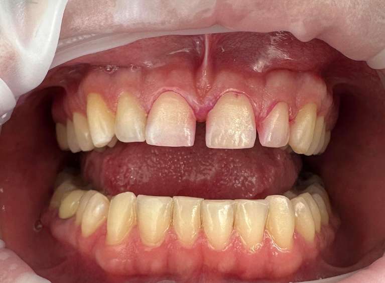 Non- Invasive Dental Treatment in Charlotte- Before