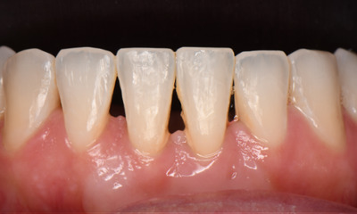 Before treatment - Removing Black Triangles with Bioclear