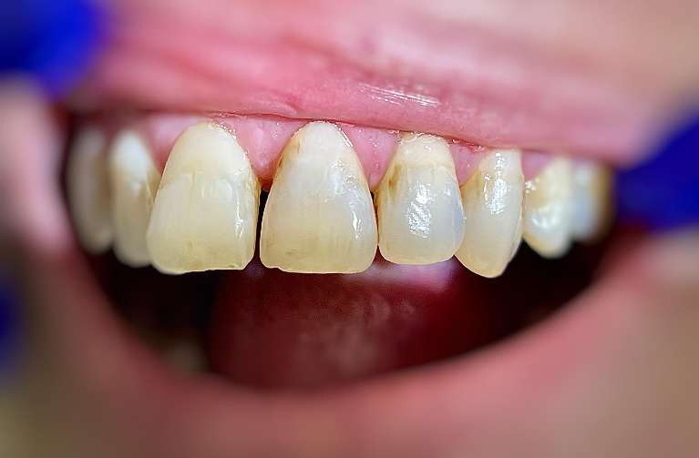 Results-with-BioClear-Before-Image