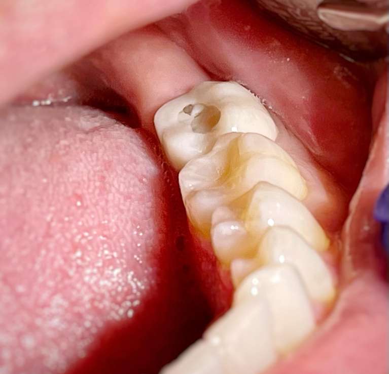 dental crowns in south charlotte- before photo